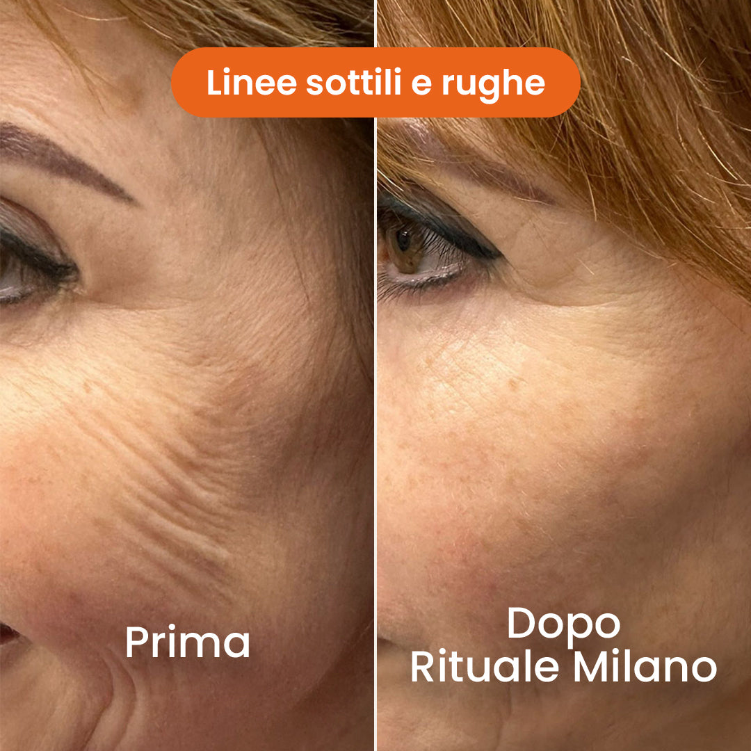 Il Sistema di Micro-Infusione